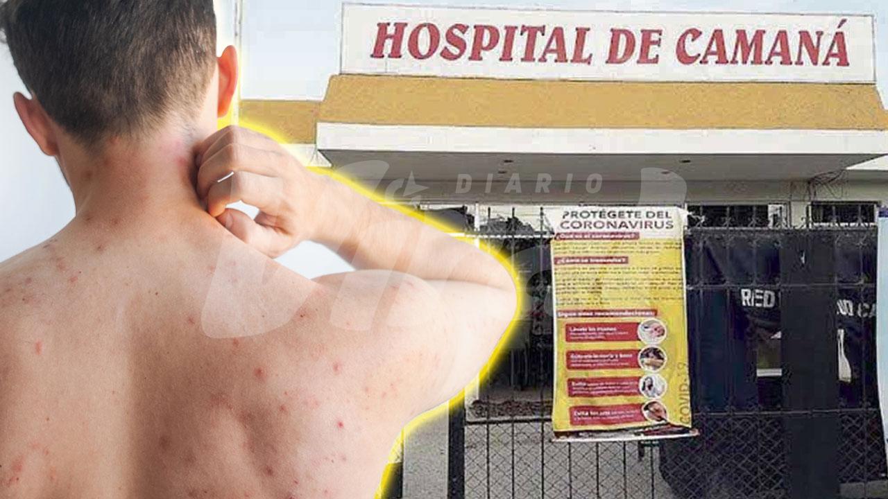 Camaná es la provincia con más casos de sarampión en la región