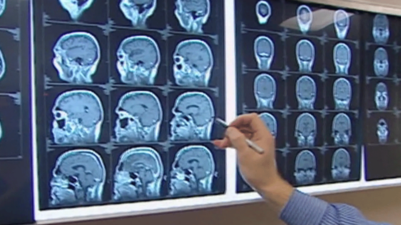 La memoria envejece con todo el cerebro: estudio global revela una vulnerabilidad estructural más amplia