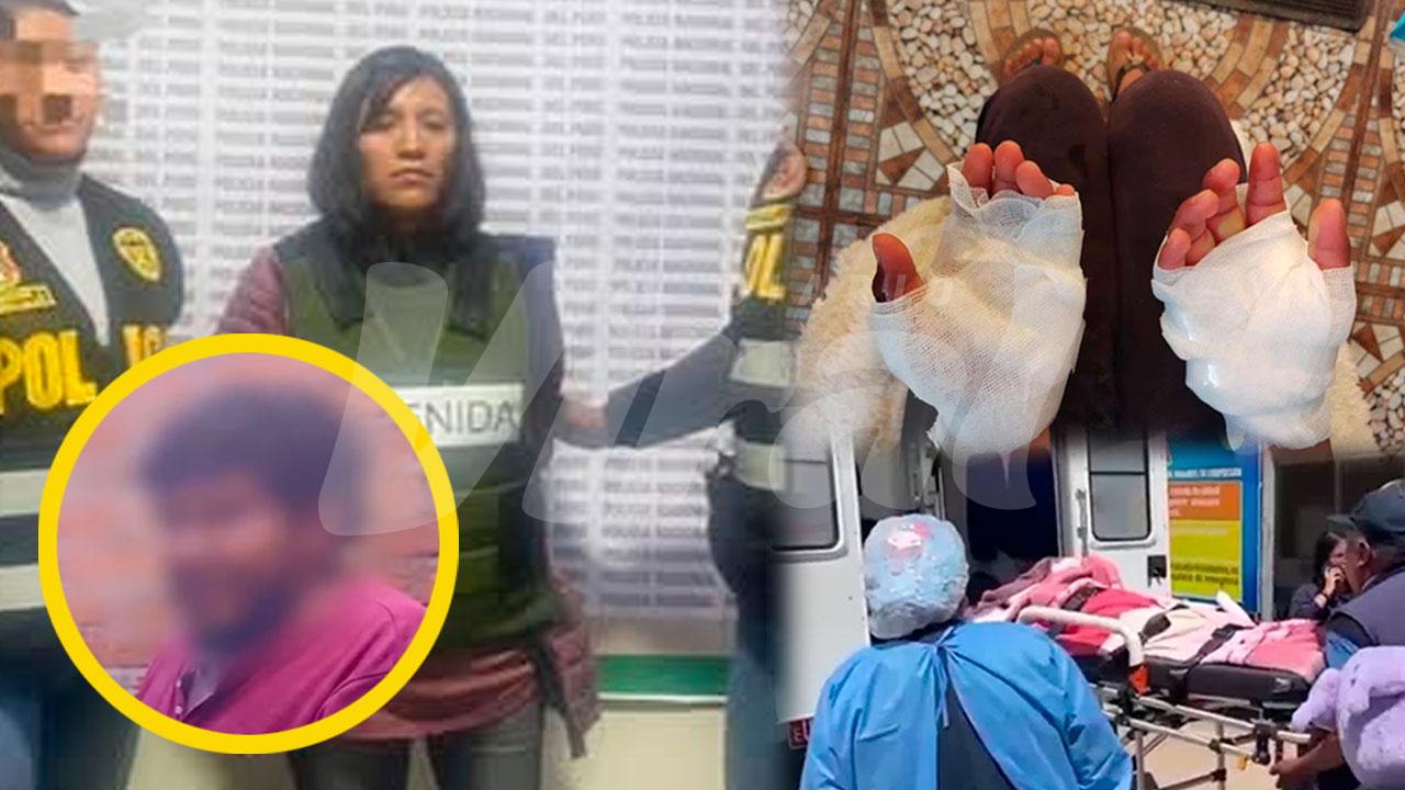 Niña evacuada a Arequipa con 40% del cuerpo quemado